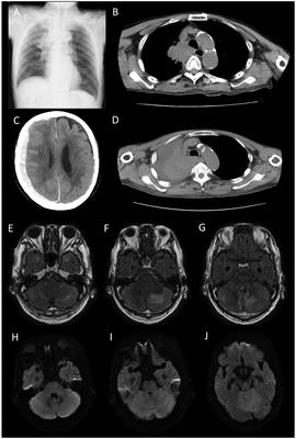 Case report: An autopsy report of patient with metastatic brain tumor and carcinomatous meningitis mimicking paraneoplastic neurological syndrome